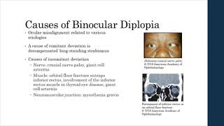 Binocular vs Monocular Diplopia [upl. by Yraek986]