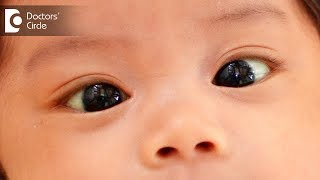 How to detect squint in kids  Dr Anupama Kumar [upl. by Popper]