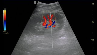 Renal Doppler Ultrasound [upl. by Elohc]