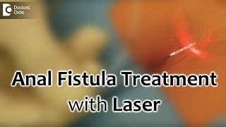 Anal Fistula Treatment with Laser Painless and best recovery for fistula  Dr Rajasekhar M R [upl. by Elle]