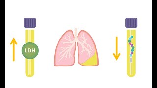 Differentiating transudative and exudative effusions transudate vs exudate [upl. by Lamahj]