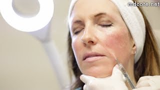 Full Face Rejuvenation with Hyaluronic Acid Fillers [upl. by Nuawed]