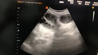 Paralytic ileus ultrasound [upl. by Felicidad]