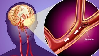 Stroke Prevention amp Transient Ischemic Attack TIA [upl. by Rupert296]