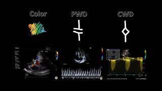 Spectral Doppler [upl. by Candis]