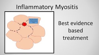 Myositis Inflammatory Myopathy Treatment [upl. by Drofdarb]