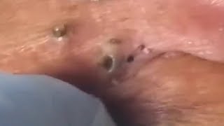 LARGE Blackheads Removal  Satisfying Blackhead 2019 Part 04 [upl. by Edison567]