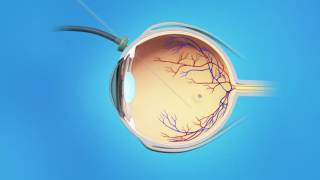 Macular Hole Vitrectomy Surgery [upl. by Ardnoel912]