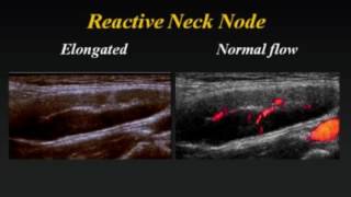 Ultrasound of Cervical Lymph Nodes [upl. by Ellekim]