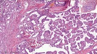 Papillary Thyroid Carcinoma  Histopathology [upl. by Siseneg585]