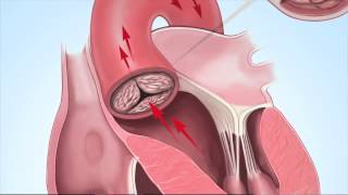 Understanding Aortic Stenosis with Dr Marc Gillinov [upl. by Musetta862]