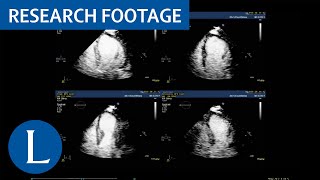 Dobutamine stress echocardiography to diagnose coronary artery disease [upl. by Shamus]