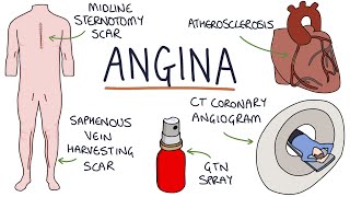 Understanding Angina Visual Explanation for Students [upl. by Steffy]