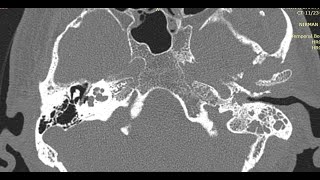 How to Read HRCT Temporal Bone  All Basics in Detail [upl. by Anirt]