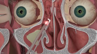 Chapter 3 Nasal and Sinus Problems and Solutions [upl. by Enelear]