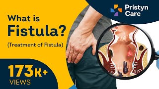 What is Fistula  Symptoms amp Treatment of Fistula [upl. by Zonnya124]