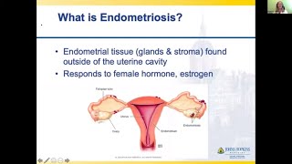 Myths amp Misconceptions Understanding Endometriosis and Uterine Fibroids Webinar [upl. by Scopp]