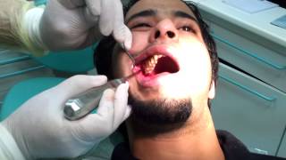 Third molar Extraction wisdom tooth [upl. by Ridgley]