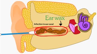 Ear Wax Removal  2D Animation [upl. by Connor]