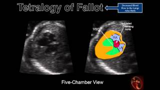 Fetal Echocardiography Tetralogy of Fallot [upl. by Ennyleuqcaj]