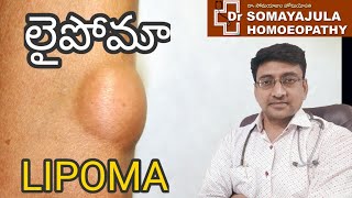 LIPOMA Homeopathic Treatment  Telugu  Dr Suresh Somayajula [upl. by Onairot360]