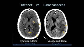 Intro to Head CT Part II Evaluation of Ischemic Stroke [upl. by Chip]