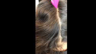 EXTREME HEAD LICE REMOVAL [upl. by Aydin]