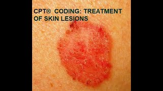 CPT® coding for Skin Lesions [upl. by Notterb]