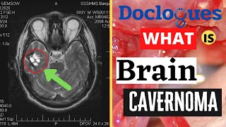 What Is Brain Cavernoma [upl. by Cliff341]