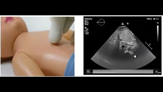 Basics of Pediatric Echocardiography Determining the Situs by Dr Gaurav Agrawal [upl. by Ahsocin418]