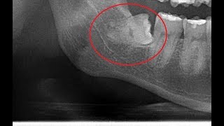 Horizontally impacted lower 3rd molar removal [upl. by Launcelot680]