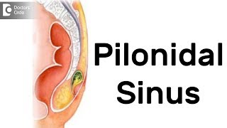 What is Pilonidal Sinus Symptoms Diagnosis Treatment  Dr Rajasekhar M R [upl. by Esmerelda]