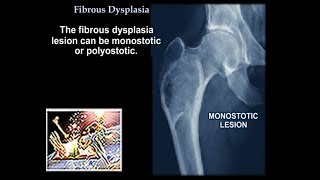 ameloblastoma lecture I oral pathology lectures [upl. by Lesya]