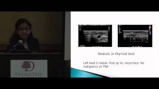 Thyroid Cancer Lymph Node Evaluation amp Mapping Pre amp PostOperative Dr Patel ThyCa Conference [upl. by Cheng961]