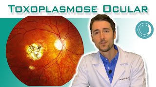 Toxoplasmose ocular  tratamento [upl. by Lipsey]