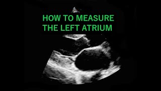 ECHOCARDIOGRAM How to measure the Left Atrium Diameter [upl. by Refanej]