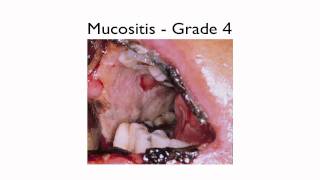 What is Mucositis [upl. by Aicnom]