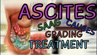 What are Ascites Transudate vs Exudate  SAAG  Fluid Wave Test  Shifting Dullness  Treatment [upl. by Elstan]