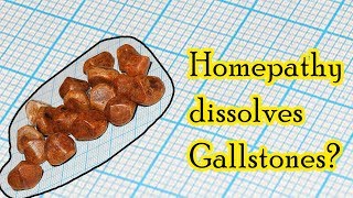 Can homeopathic medicine dissolve gallstones  Dr Sanjay Panicker [upl. by Hurlee]