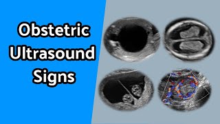 Obstetric Ultrasound Signs [upl. by Ennaerb]