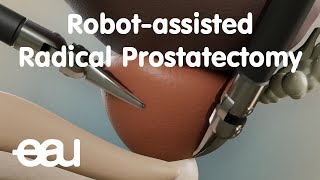 Robotassisted Radical Prostatectomy RARP [upl. by Emmery]