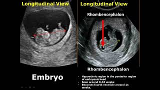 First Trimester amp Ectopic Pregnancy Ultrasound Image Appearances [upl. by Acsirp]