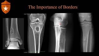 Imaging of Bone Tumors [upl. by Pegg]