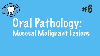 Oral Pathology  Mucosal Malignant Lesions  INBDE ADAT [upl. by Nemsaj523]