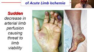 Acute Ischemia  OVERVIEW [upl. by Zellner]