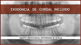 Cirugía Bucal II Exodoncia de Cordal Incluido [upl. by Yaned862]