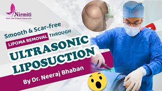 Lipoma Removal By Ultrasonic Liposuction [upl. by Aicsila890]