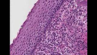 Histopathology Cervix  Squamous cell carcinoma [upl. by Tikna]