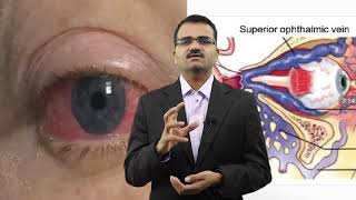 Carotid Cavernous FistulaCCFSymptoms Causes and Treatment  DrMRavi KumarNeurosurgeonHyderabad [upl. by Leroi]