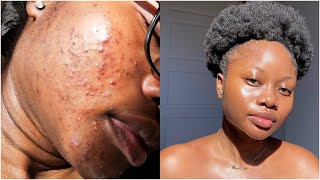 my skincare routine for acne amp scars finally [upl. by Nerro]